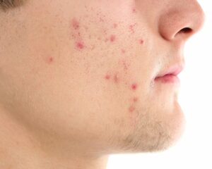 Acne Before 1 300x240