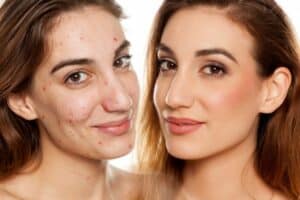 acne-treatment-oxford-results-scaled-600x400