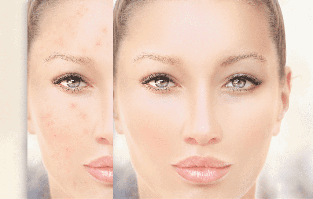 Microneedling For Acne Scars Before And After
