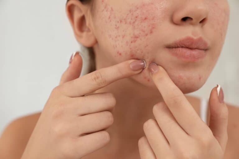 acne-scars-4