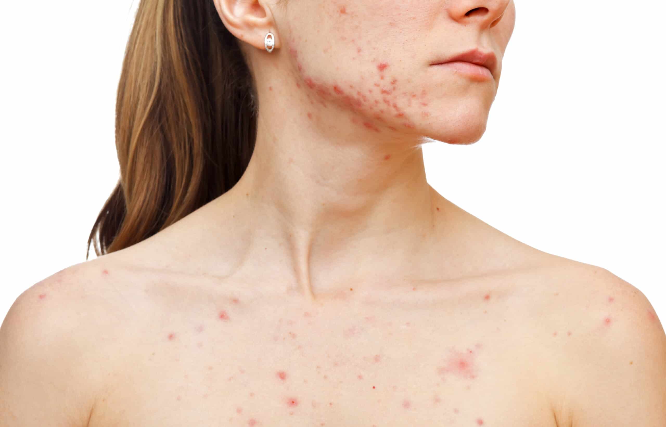 Acne Scars Scaled