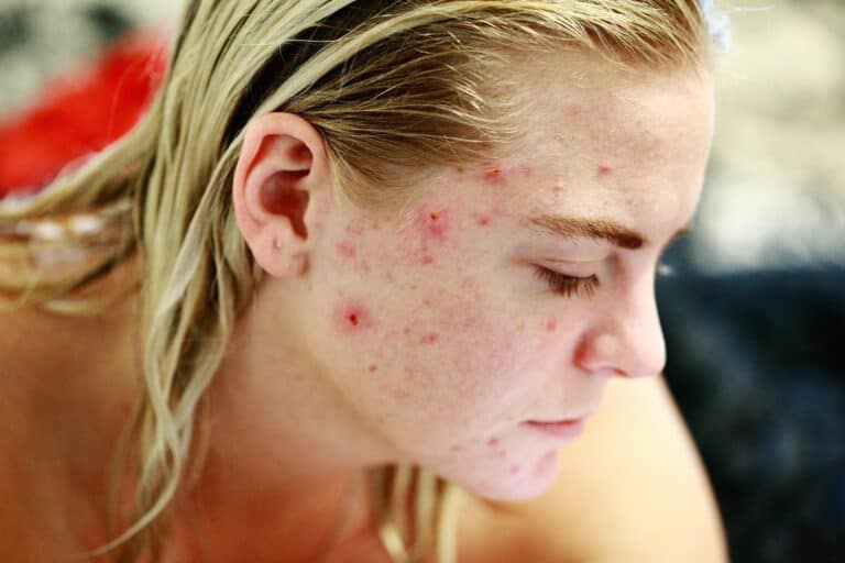 acne-struggle