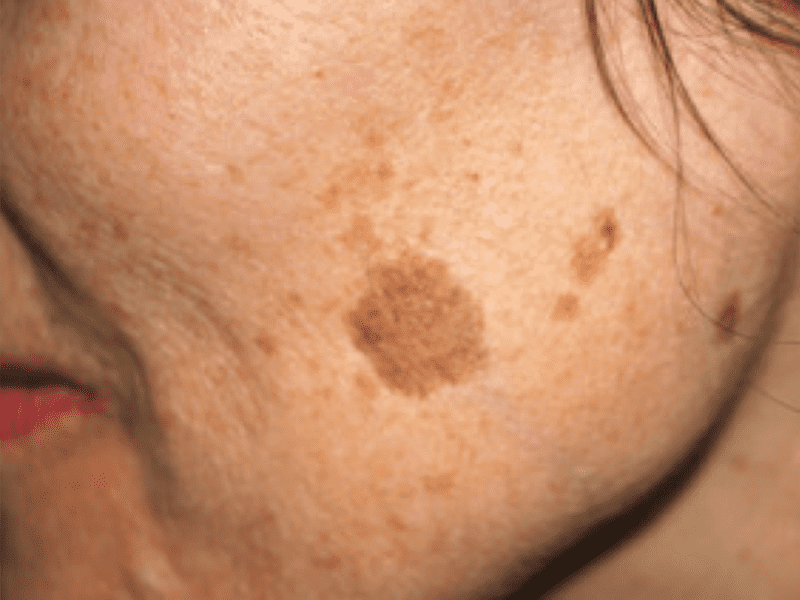 age spot removal