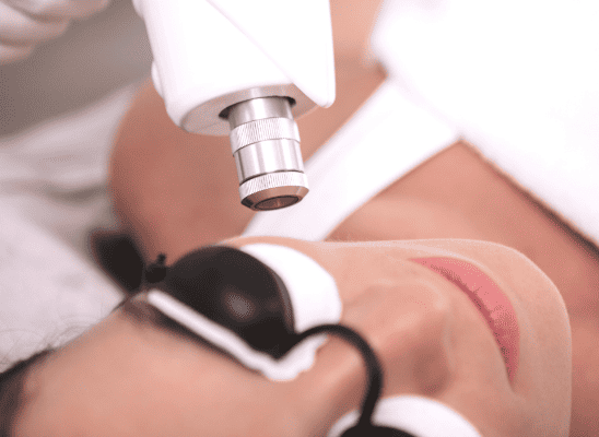 Laser Treatment For Acne Scars How Many Sessions Does It Take E1661499357592