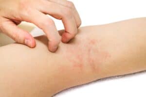 Eczema And Skin Rashes 300x200