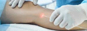 endovenous laser treatment