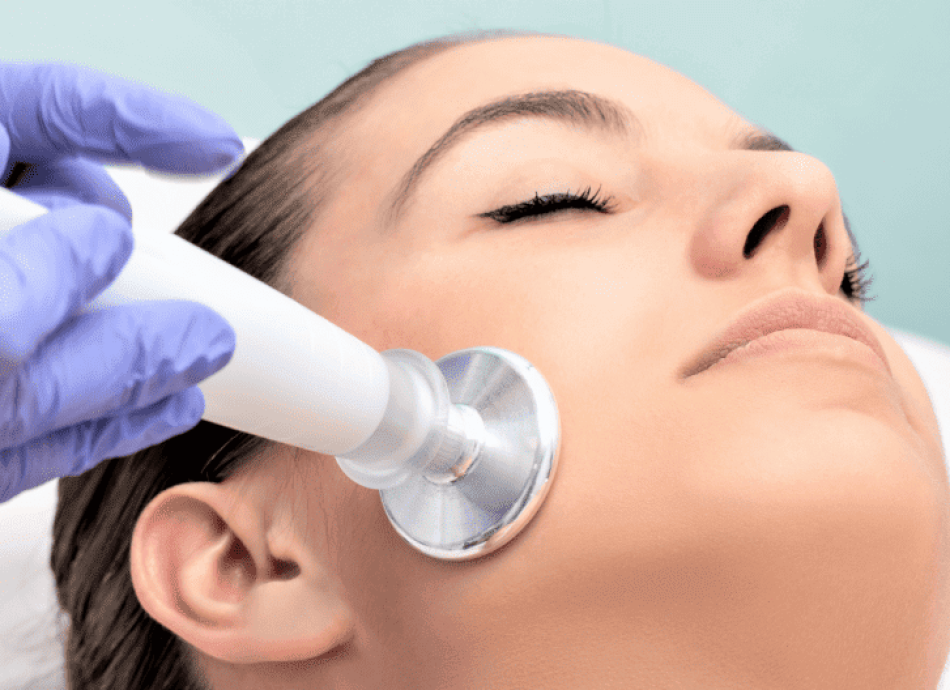 Microdermabrasion-to-get-rid-of-acne-scars-e1653645230734